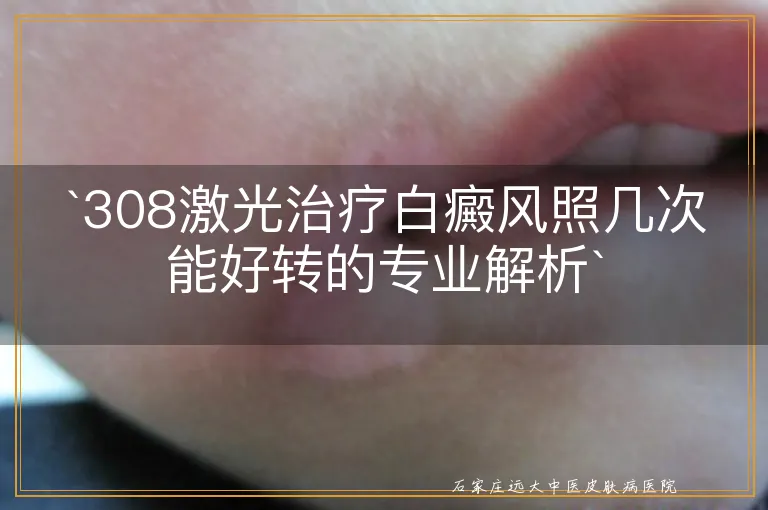 `308激光治疗白癜风照几次能好转的专业解析`