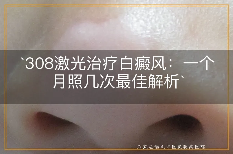 308激光治疗白癜风：一个月照几次最佳解析