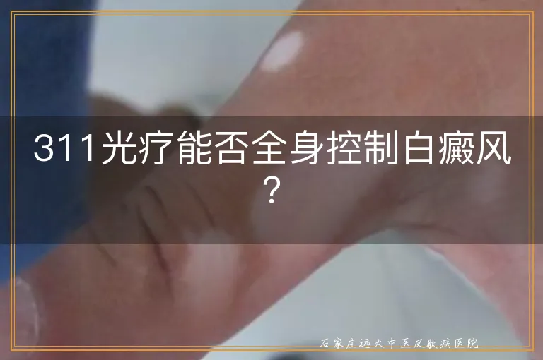 311光疗能否全身控制白癜风？