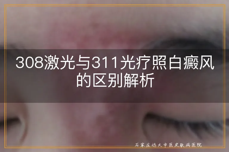 308激光与311光疗照白癜风的区别解析