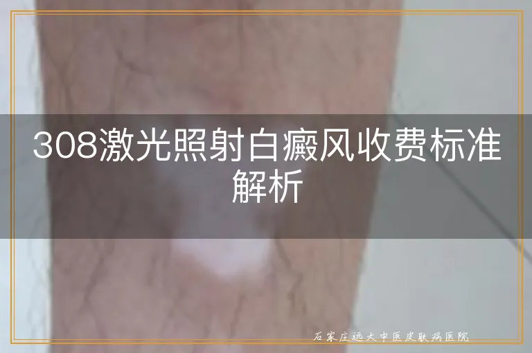 308激光照射白癜风收费标准解析