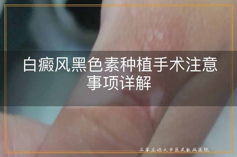 白癜风黑色素种植手术注意事项详解