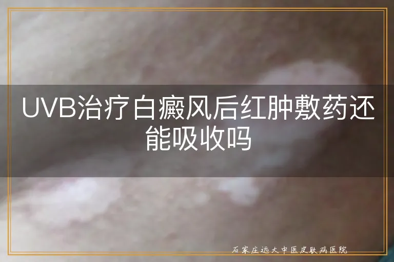 UVB治疗白癜风后红肿敷药还能吸收吗