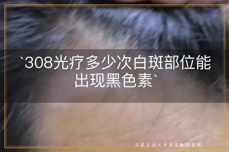 `308光疗多少次白斑部位能出现黑色素`