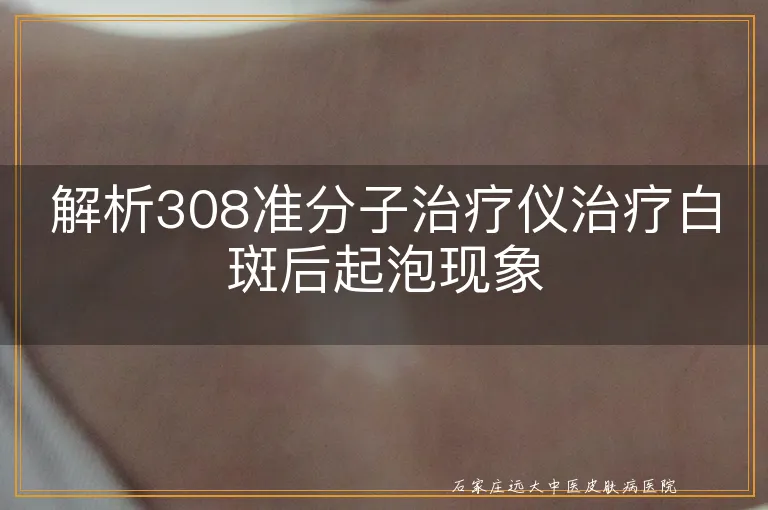 解析308准分子治疗仪治疗白斑后起泡现象