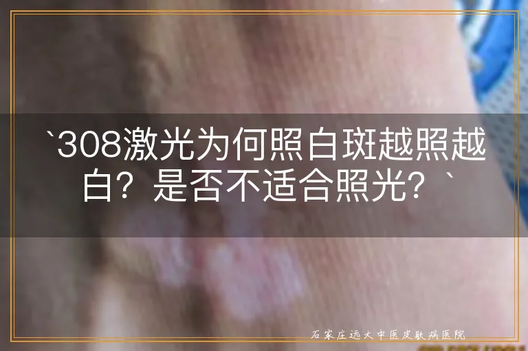 `308激光为何照白斑越照越白？是否不适合照光？`