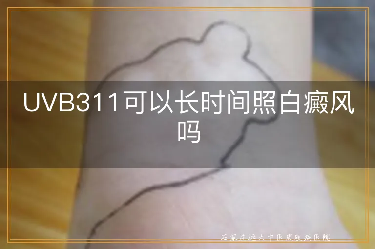 UVB311可以长时间照白癜风吗