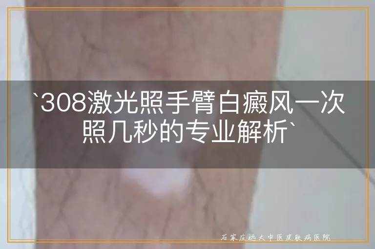 `308激光照手臂白癜风一次照几秒的专业解析`