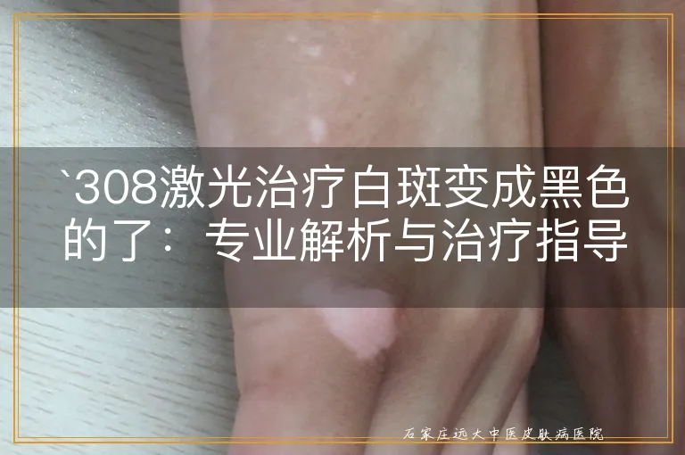 `308激光治疗白斑变成黑色的了：专业解析与治疗指导`