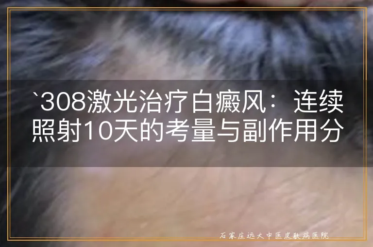 `308激光治疗白癜风：连续照射10天的考量与副作用分析`