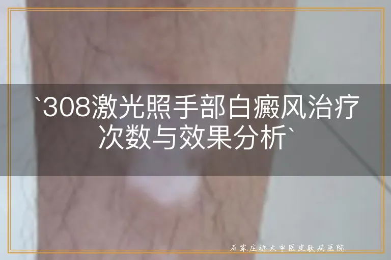 `308激光照手部白癜风治疗次数与效果分析`