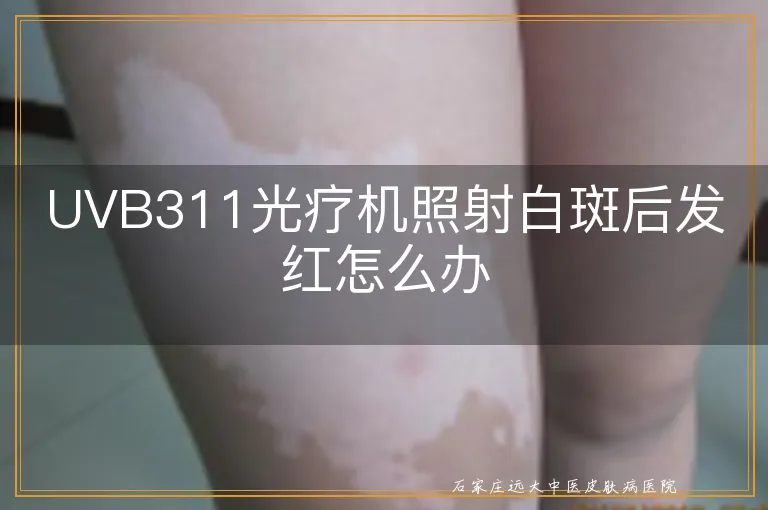 UVB311光疗机照射白斑后发红怎么办