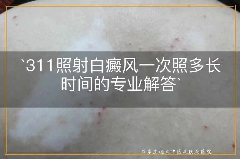 `311照射白癜风一次照多长时间的专业解答`