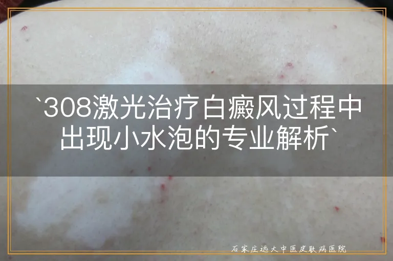 `308激光治疗白癜风过程中出现小水泡的专业解析`