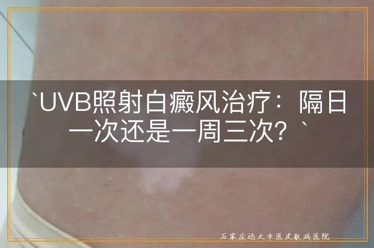 `UVB照射白癜风治疗：隔日一次还是一周三次？`