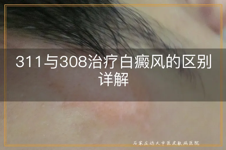 311与308治疗白癜风的区别详解