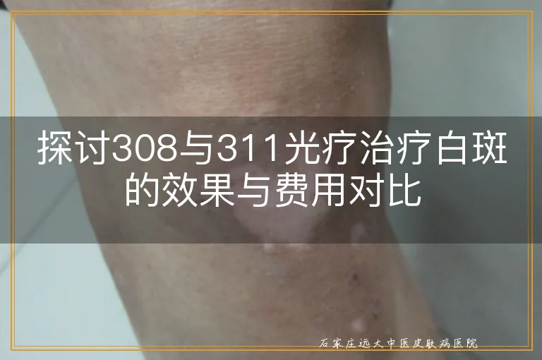 探讨308与311光疗治疗白斑的效果与费用对比