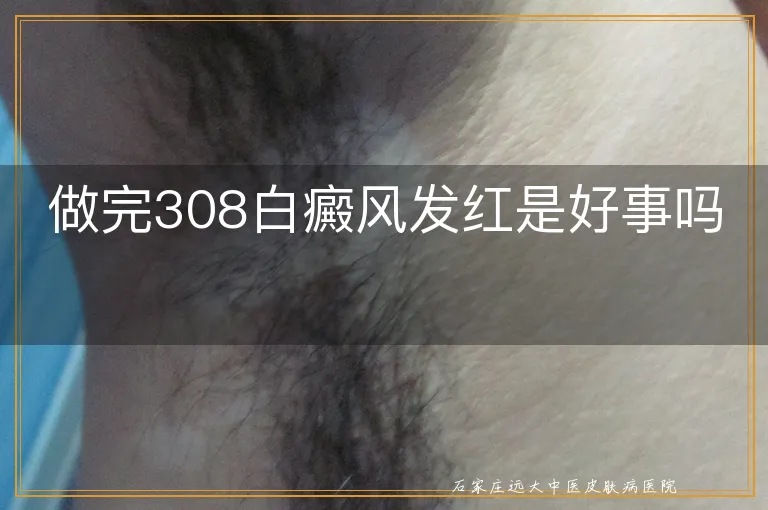 做完308白癜风发红是好事吗