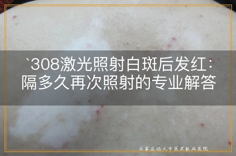 `308激光照射白斑后发红：隔多久再次照射的专业解答`