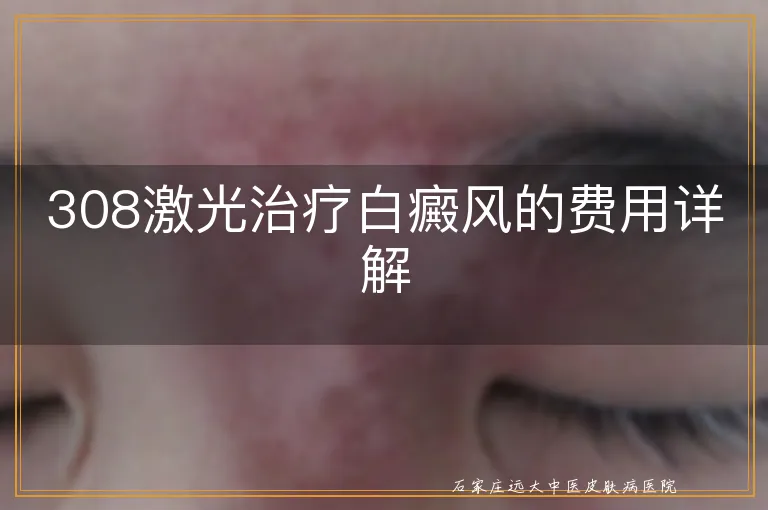 308激光治疗白癜风的费用详解