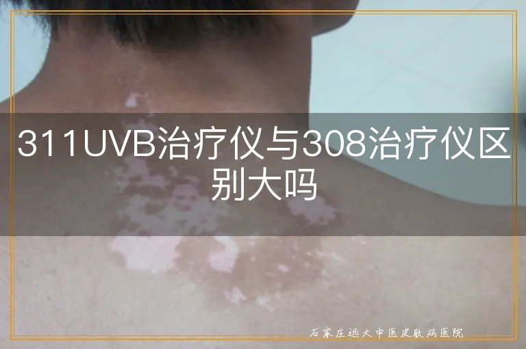 311UVB治疗仪与308治疗仪区别大吗