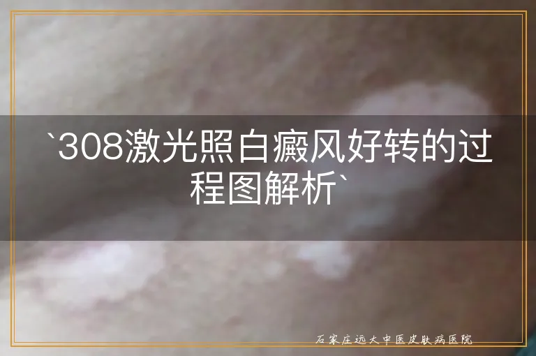 `308激光照白癜风好转的过程图解析`