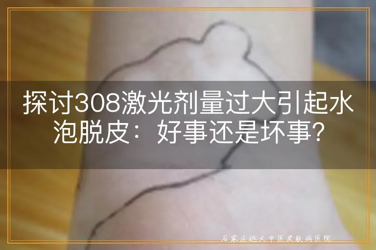 探讨308激光剂量过大引起水泡脱皮：好事还是坏事？