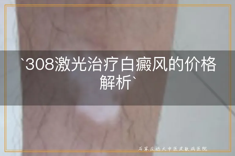 `308激光治疗白癜风的价格解析`