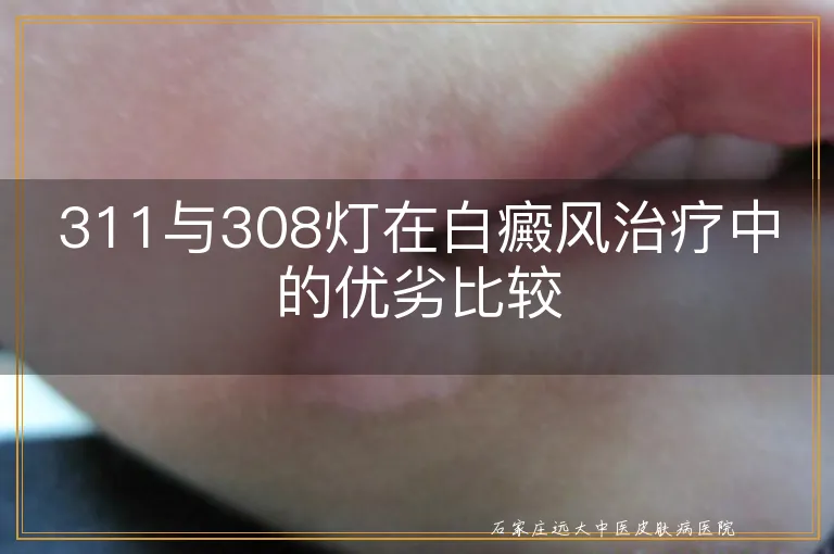 311与308灯在白癜风治疗中的优劣比较