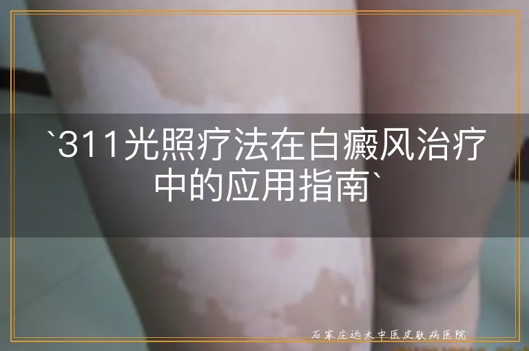 `311光照疗法在白癜风治疗中的应用指南`