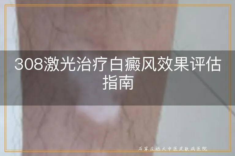 308激光治疗白癜风效果评估指南