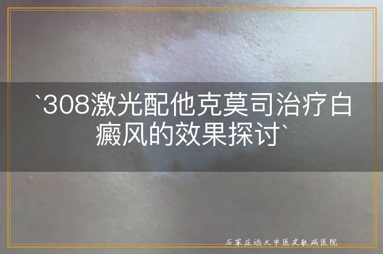 `308激光配他克莫司治疗白癜风的效果探讨`