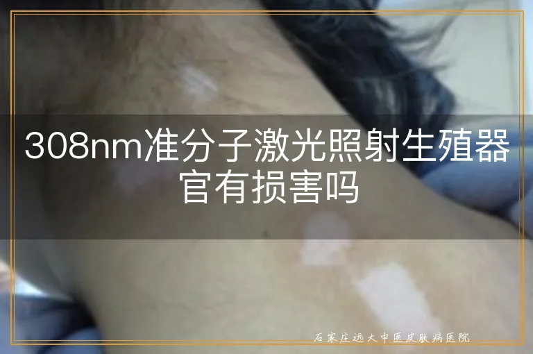 308nm准分子激光照射生殖器官有损害吗