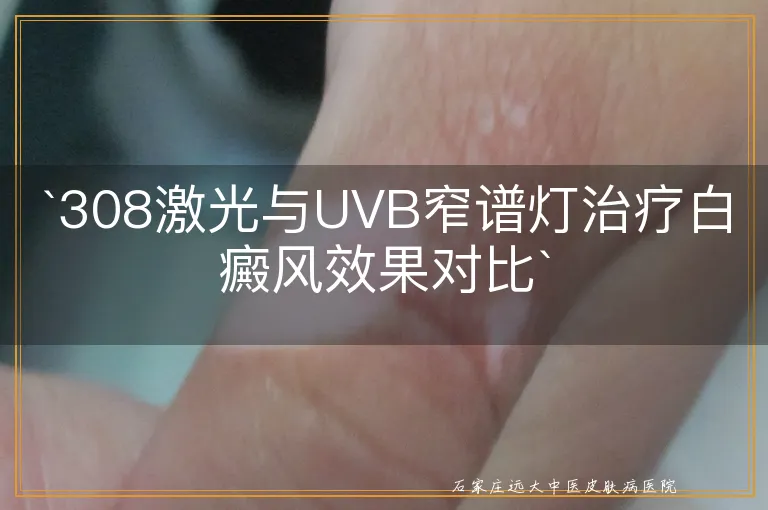 `308激光与UVB窄谱灯治疗白癜风效果对比`