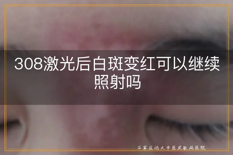 308激光后白斑变红可以继续照射吗