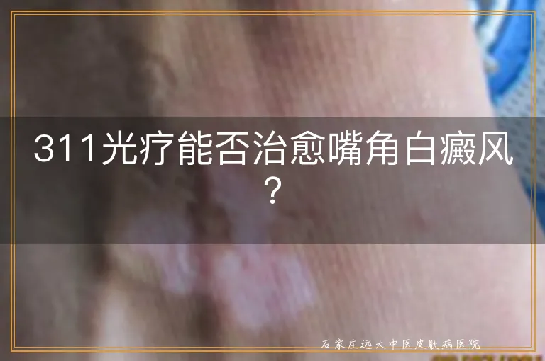 311光疗能否治愈嘴角白癜风？