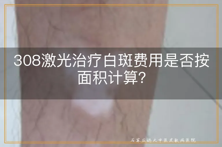 308激光治疗白斑费用是否按面积计算？