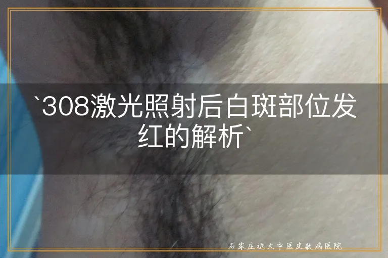 `308激光照射后白斑部位发红的解析`