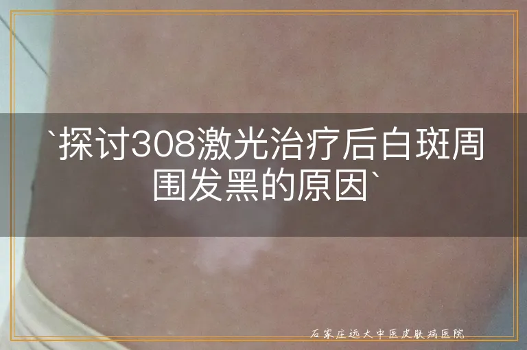 `探讨308激光治疗后白斑周围发黑的原因`