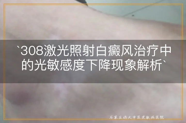 `308激光照射白癜风治疗中的光敏感度下降现象解析`