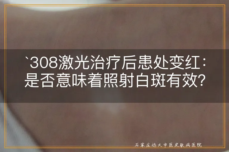 `308激光治疗后患处变红：是否意味着照射白斑有效？`