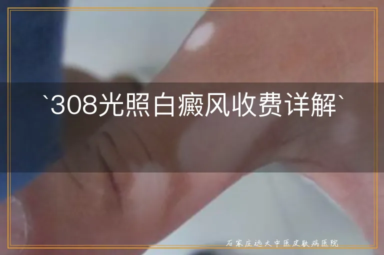 `308光照白癜风收费详解`