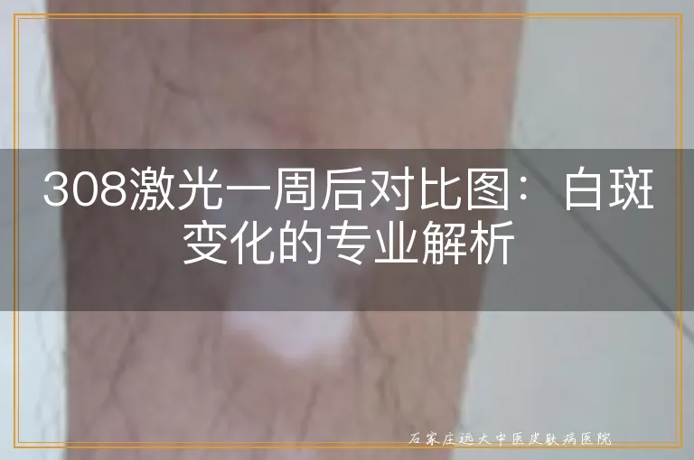 308激光一周后对比图：白斑变化的专业解析