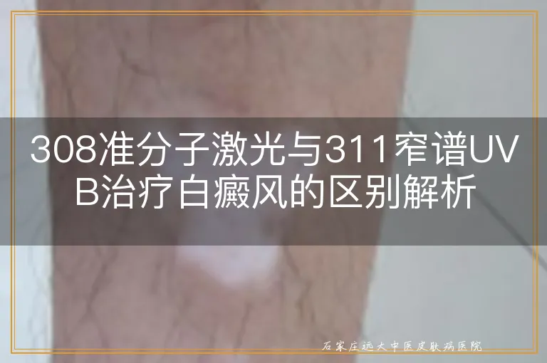 308准分子激光与311窄谱UVB治疗白癜风的区别解析