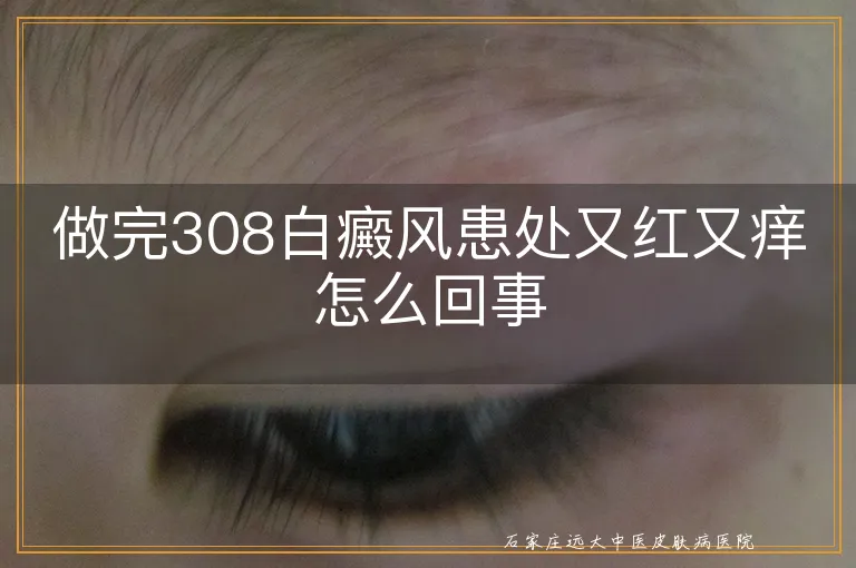 做完308白癜风患处又红又痒怎么回事