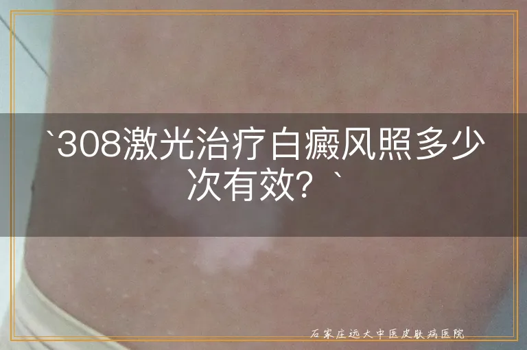 `308激光治疗白癜风照多少次有效？`