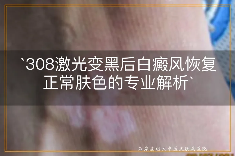 `308激光变黑后白癜风恢复正常肤色的专业解析`