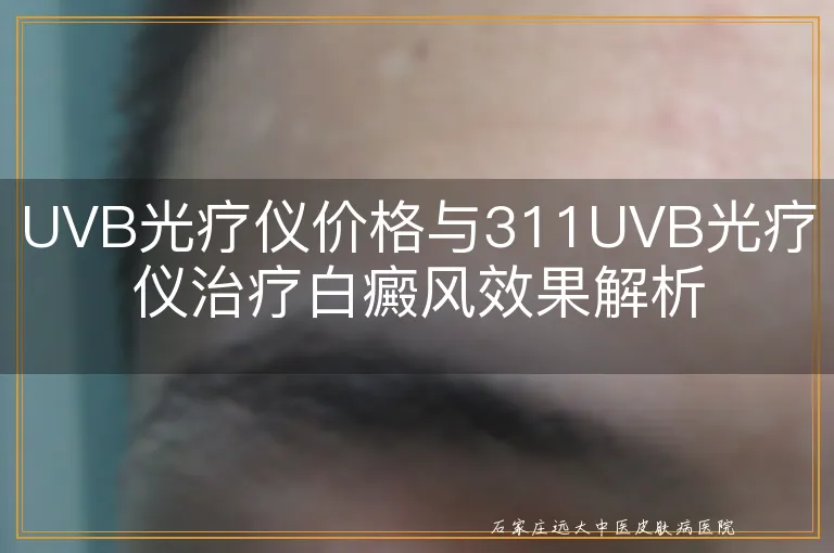 UVB光疗仪价格与311UVB光疗仪治疗白癜风效果解析