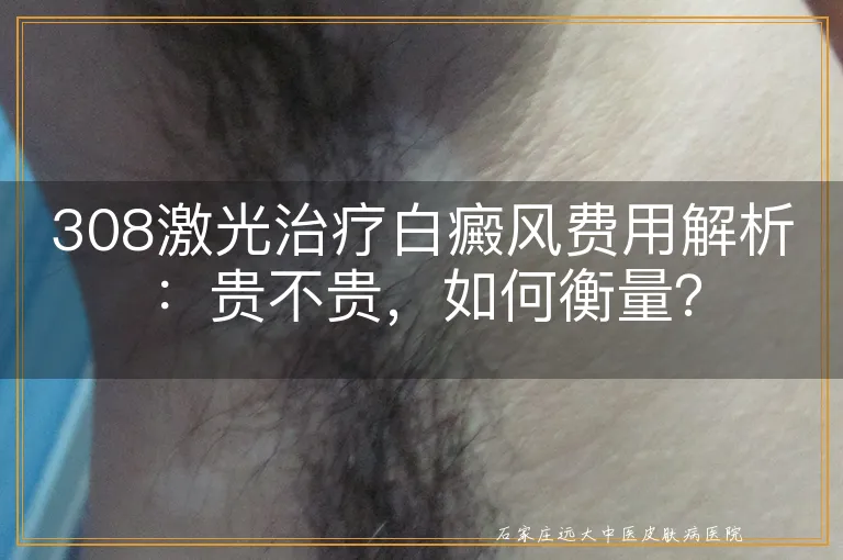 308激光治疗白癜风费用解析：贵不贵，如何衡量？