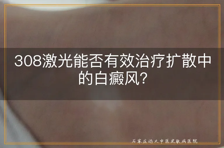 308激光能否有效治疗扩散中的白癜风？